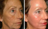 2 einfache Möglichkeiten, um Falten im Gesicht zu Hause ohne Operation und ohne Kosmetikerin zu entfernen