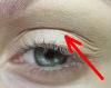 Wie wird man ohne Kunststoffe von gesenkten Augenlidern befreien