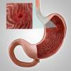 Gastritis oder Erosion des Magens: die wichtigsten Symptome, Behandlung, Diät