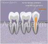 So finden und behandeln Sie Zahnkanäle in Lumident
