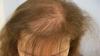 Natürliche Halbmaske für Haarausfall