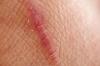 Narben auf der Haut: was es ist und wie sie entfernen