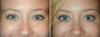 Was Kombination von kosmetischen Verfahren wird Effekt für Ihr Gesicht bombichesky