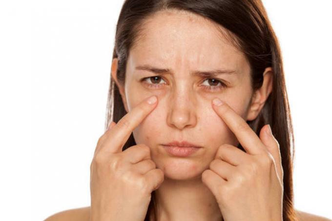 Wie wird man für 10 Minuten von blauen Flecken unter den Augen loswerden?