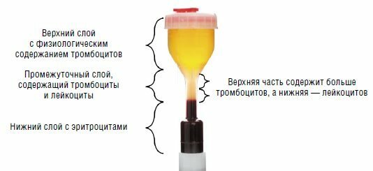 Dies ist, wie wie ein Reagenzglas für PRP-Therapie aussehen sollte. Quelle: Medizinische Wissenschaft und Praxis-Portal „behandelnden Arzt“