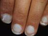 Warum aufhellen Fingernägel
