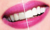 Wie Sie Ihre Zähne zu Hause aufhellen? Zahn Beratung.