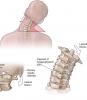 4 grundlegende Übungen für die Halswirbelsäule helfen Ihnen, Schmerzen und Osteochondrose zu vergessen!