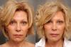Wie funktioniert Botox und warum einige Prominente, nachdem es Gesichter „verzerrt“