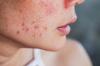 Wie Sie Ihre Haut nach dem Sommer aufräumen: Behandlungen zu Hause und im Salon