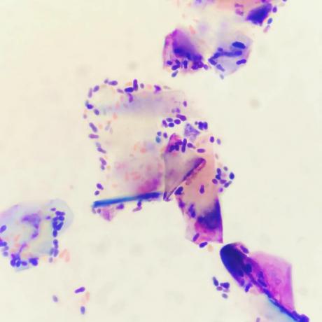 Der Pilz Malassezia. viele Sorten von Dermatitis mit ihm verbunden ist. Aber das ist ein anderes Thema zur Diskussion
