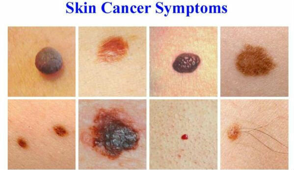 Symptome von Hautkrebs